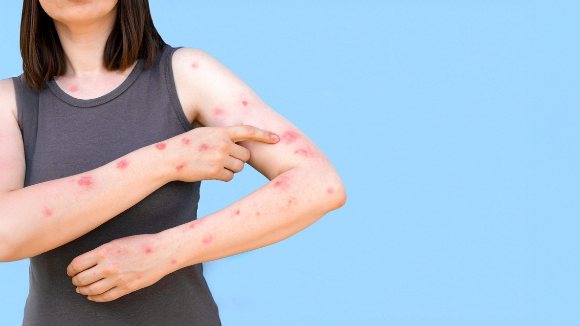 Ceará confirma primeiro caso de Mpox em 2026